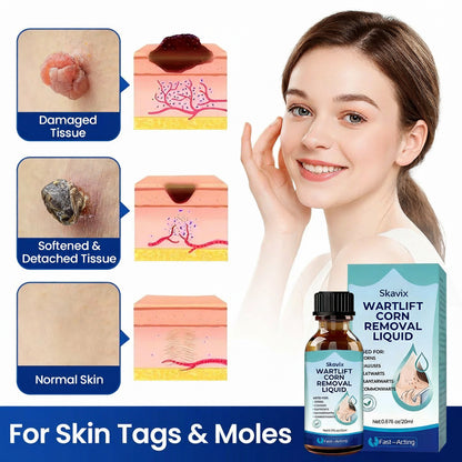 Skavix WartLift Corn Removal Liquid