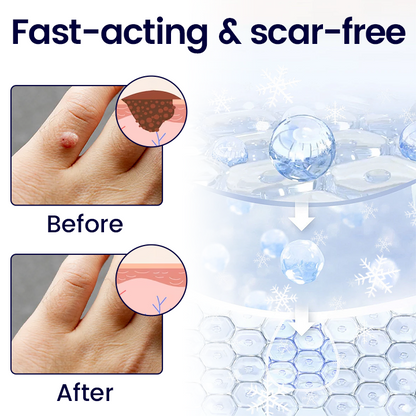 BBOJI WartErase Cryo Freeze Spray